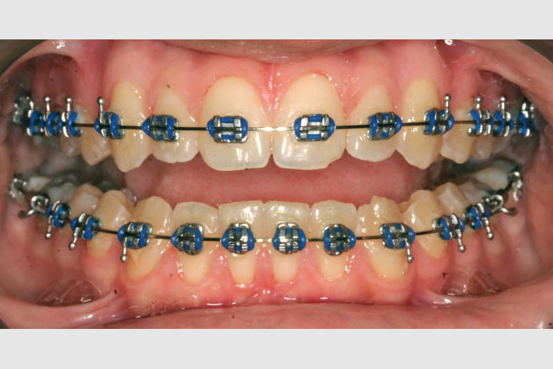 Thicker Wire Braces - Fine Orthodontics
