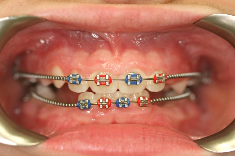 types of metal braces brackets